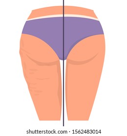 Cellulite on the hips vector isolated. Before and after, female body. Healthy skin and weight loss concept.