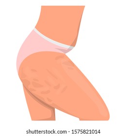 Cellulite on the hips vector isolated. Female body. Healthy skin and weight loss concept.