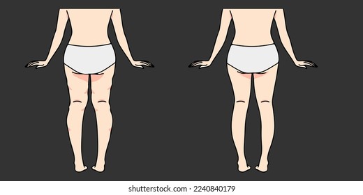 Cellulite removal, Before and after cellulite removal