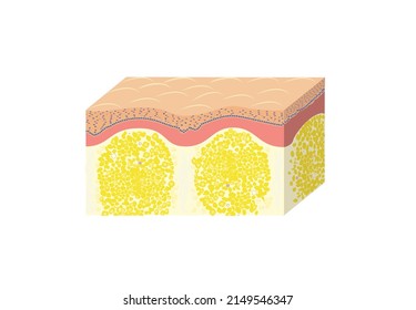 Cellulite Scheme Histology Of Skin, Vector