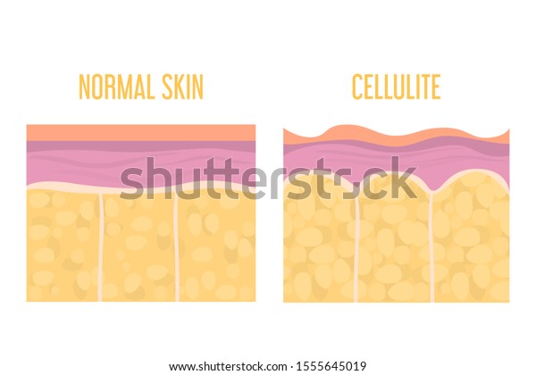 Cellulite skin and healthy skin\
anatomy. Fat tissue of human body vector isolated. Epidermis and\
dermis texture. Medical illustration of human cellulite\
skin.