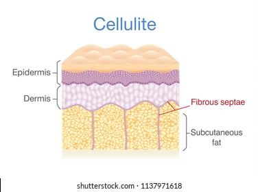 Cellulite skin layer of human. Illustration about health diagram.