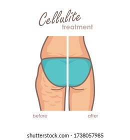 Tratamiento con celulitis. Antes y después de perder peso. Ilustración vectorial del culo femenino. Para su diseño