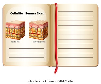 Celulitis bajo ilustración de la piel humana
