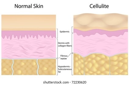 Cellulite Versus Smooth Skin