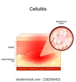 cellulitis. Cross section of layers of the human Skin with symptoms of Infectious disease. Close-up of Staphylococcus aureus. bacterial infection. Bacteria involving the inner layers of the skin