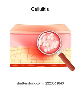 cellulitis. Cross section of layers of the human Skin. Adipose tissue with symptoms of Infectious disease. Close-up of Staphylococcus. bacterial infection through a magnifying glass. dermatology svg