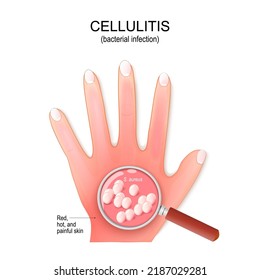 Cellulitis. Humans palm with bacterial infection. Close-up of bacterial colony. magnifying glass and Staphylococcus aureus. vector illustration