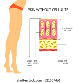 Cellulitis Vector illustration The structure of the adipose tissue with normal body weight and no cellulite Infographics
