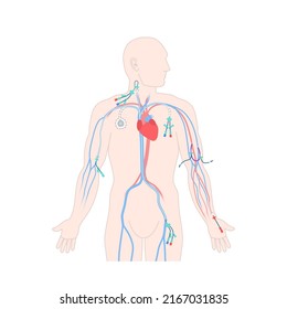Central venous catheter placement sites shown on the male body. Types of central lines. Man with CVC access devices. PICC, arterial line, implantable port for infusion. Medical vector illustration.