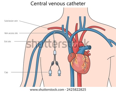 Central venous catheter structure diagram hand drawn schematic vector illustration. Medical science educational illustration