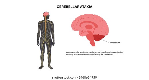 Cerebellar ataxia medical poster. Degenerative disease of the nervous system. Slurred speech, stumbling, falling, lack of coordination. Poor muscle control, clumsy movements flat vector illustration