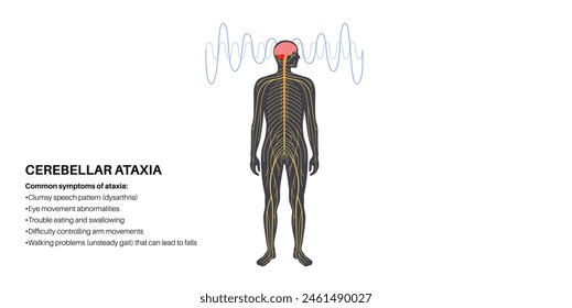 Cerebellar ataxia medical poster. Degenerative disease of the nervous system. Slurred speech, stumbling, falling, lack of coordination. Poor muscle control, clumsy movements flat vector illustration