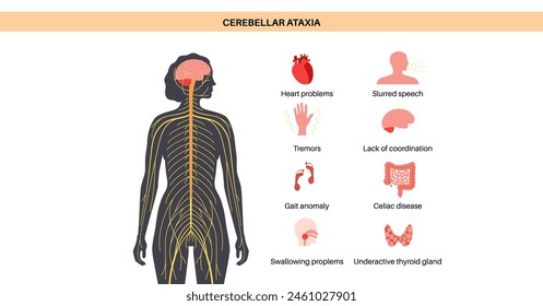 Cerebellar ataxia poster. Degenerative disease of the nervous system, main symptoms. Slurred speech, stumbling, falling, lack of coordination. Poor muscle control, clumsy movements vector illustration