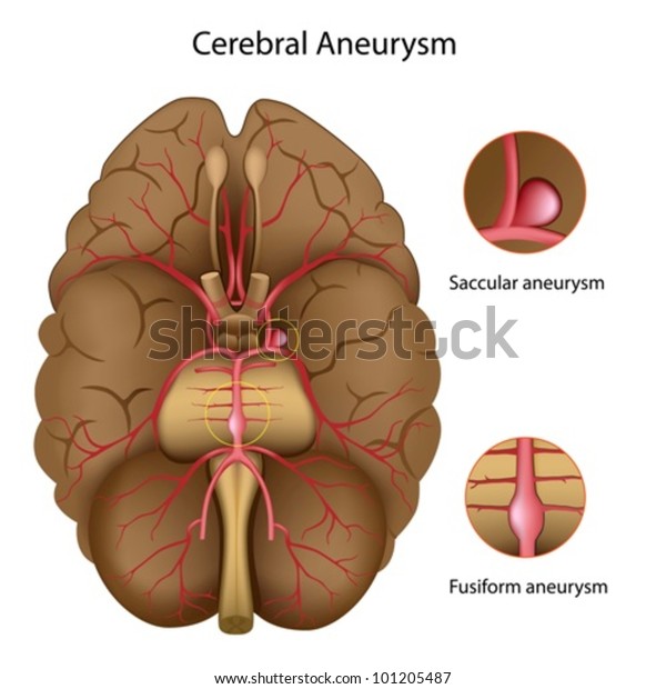 Cerebral Aneurysm Stock Vector (Royalty Free) 101205487