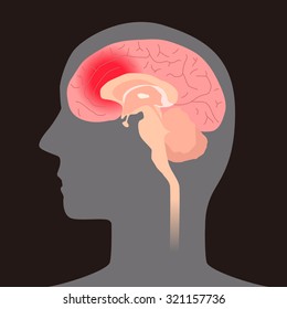 cerebral hemorrhage, concept illustration