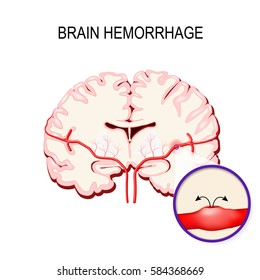 Cerebral Hemorrhage. Stroke And Bleeding Inside The Human Brain.