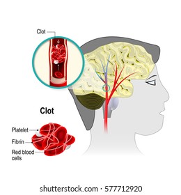 Cerebral Infarction. Brain Stroke. The Obstruction Is Caused By A Blood Clot That Forms In A Cerebral Artery. Blood Cells Blocked Of Blood Flow. Human Anatomy.