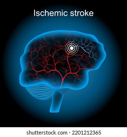Cerebral Infarction. Ischemic Stroke. Human Brain With Blood Vessel On Dark Background. Brain Ischemia Caused By A Blood Clot In An Artery Resulting In Brain Death To The Affected Area. Vector