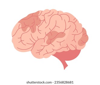 Cerebrovascular Brain Disease Vector Illustration