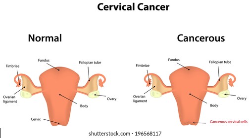 Cervical Cancer