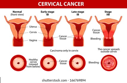 Cervical Cancer. Carcinoma Of Cervix. Malignant Neoplasm Arising From Cells In The Cervix Uteri. Vaginal Bleeding. Vector Diagram