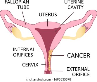 Cervical Cancer. Carcinoma of Cervix. Malignant neoplasm arising from cells in the cervix uteri. Oncology, tumor. Woman Reproductive System Anatomical Illustration. 