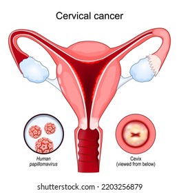 Cervical cancer. Carcinoma. Malignant neoplasm arising from cells in the cervix uteri. Close-up of the Human papillomavirus infection (HPV) that causes disease. cut-away view of the uterus. cervix