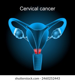 Cáncer cervical. Carcinoma. Neoplasia maligna. Ilustración vectorial como la Imagen de rayos X para el diseño de la atención sanitaria