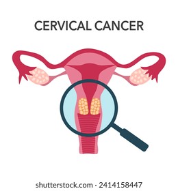 Concepto de cáncer cervical en diseño plano sobre fondo blanco.