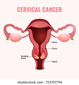 Cervical cancer development image. Detailed vector illustration with uterus and spreading cervix carcinoma. Biology, anatomy, medicine, physiology and healthcare scientific concept. 