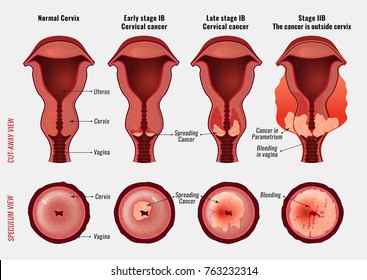 Cervical cancer development image. Detailed vector illustration with uterus and cervix carcinoma stages. Biology, anatomy, medicine, physiology and healthcare scientific concept. 