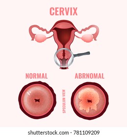 Cervical cancer development image. Detailed vector illustration with uterus and cervix carcinoma. Biology, anatomy, medicine, physiology and healthcare scientific concept. 