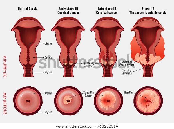 Cervical Cancer Development Image Detailed Vector Stock Vector (Royalty