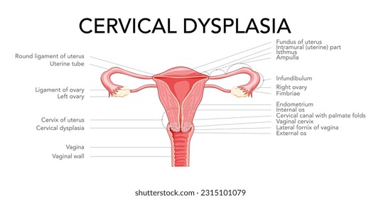 Cervical cancer diagram with inscriptions in Latin text Female reproductive system uterus. Front view in a cut. Human anatomy internal organs location scheme, ovary, fallopian tube flat style icon