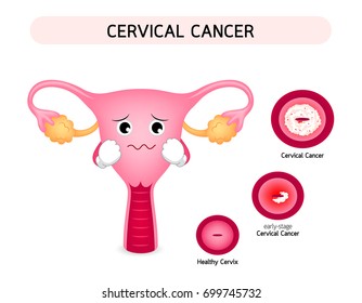 Cervical cancer diagram with sadness uterus cartoon character. Carcinoma of Cervix. Malignant neoplasm arising from cell in cervix uteri. Illustration on white background.