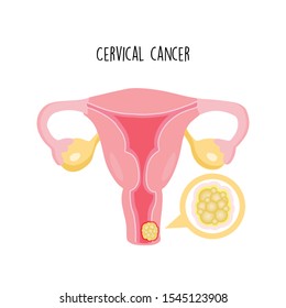 Cervical Cancer In Flat Design.