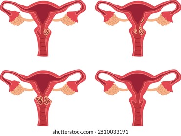 Cervical cancer progression stages vector illustration set with anatomical diagram showing normal cervix and malignant tumor growth degrees