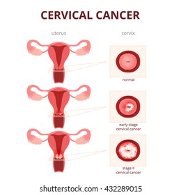 Cervical Cancer, Schematic Illustration Of The Uterus And The Cervix, Female Reproductive System Diseases