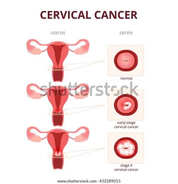 Cervical Cancer Schematic Illustration Uterus Cervix Stock Vector