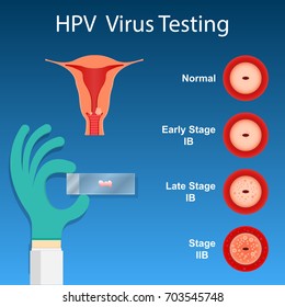 Cervical Cancer Screen Testing Examine Doctor Laboratory Checkup HPV Virus Prevent Staging by Vaginal Speculum detect vaccine