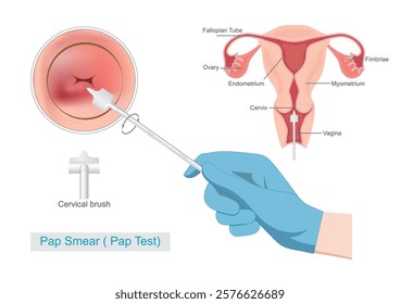 Cervical Cancer Screening by Sampling the endocervix using the cervical brush.Pap Smear( Pap Test).Thin Prep Plus Cervista HPV DNA Testing, medical healthcare, vector illustration.