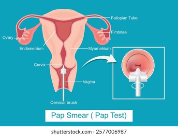 Cervical Cancer Screening or Pap Smear( Pap Test) by Sampling the endocervix using the cervical brush.Thin Prep Plus Cervista HPV DNA Testing, medical healthcare, vector illustration.