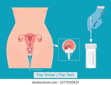 Cervical Cancer Screening or Pap Test ( Pap Smear ) by Sampling the endocervix using the cervical brush.Thin Prep Plus Cervista HPV DNA Testing, medical healthcare, vector illustration.