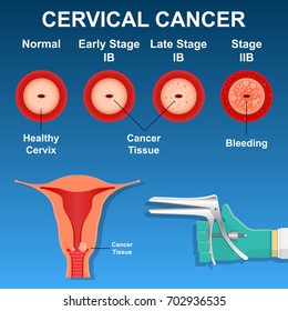 Stages of Cervical Cancer Images, Stock Photos & Vectors | Shutterstock