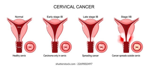 Cervical Cancer. Stages of a Carcinoma of Cervix. initially Carcinoma only in cervix then Spreading cancer in Late stage IB, and finally when Cancer spreads outside cervix. Malignant neoplasm