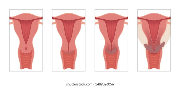 Cervical cancer. Three stages of cancer. Vector medical illustration. Female reproductive organs. Frontal view in a cut.