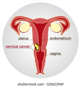 Cervical Cancer.Schematic Illustration, Vector Illustration