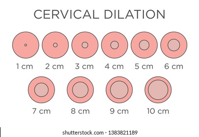 Fingertip Dilation Chart