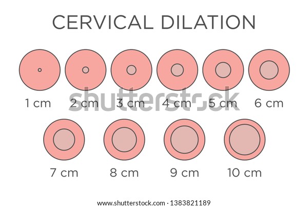 Labor Dilation And Effacement Chart